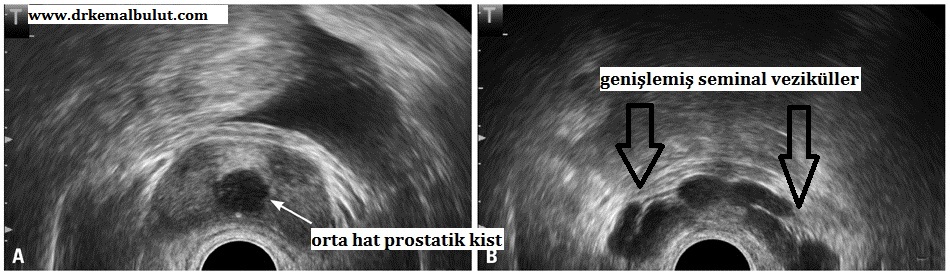 Transrektal ultrasonografide (solda)  intraprostatik orta hat kisti ve (sağda) aynı hastada seminal veziküllerde genişleme