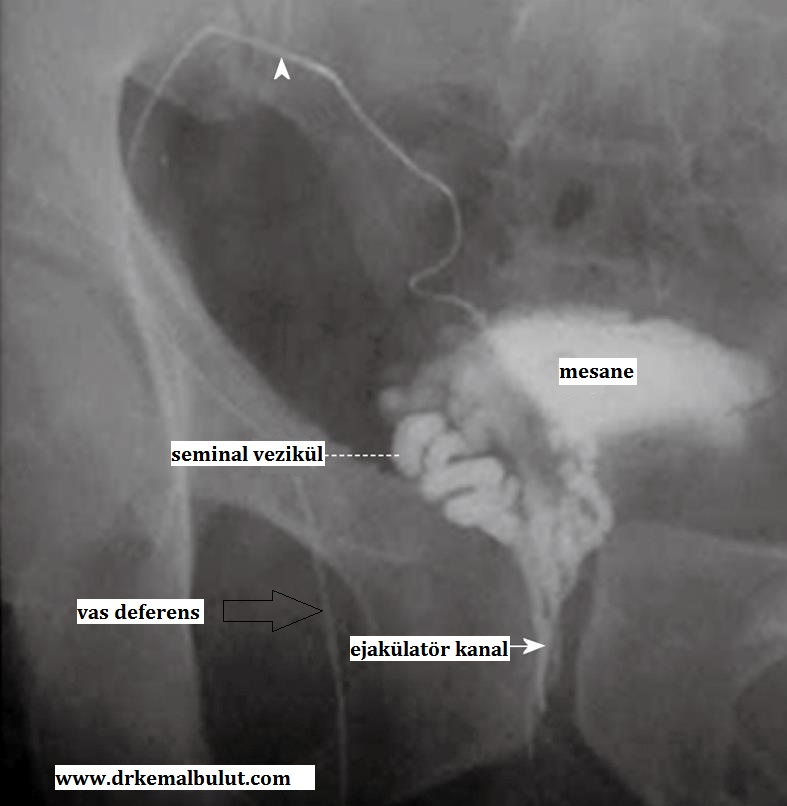 Vazavezikülografide normal bulunan anatomi