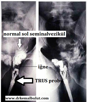 TRUS eşliğinde seminalvezikülografi ve aspirasyon, normal görünüm