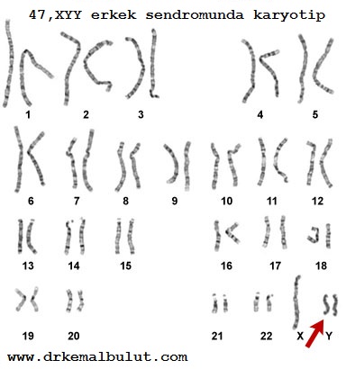 47, XYY erkek sendromunda karyotip analizi